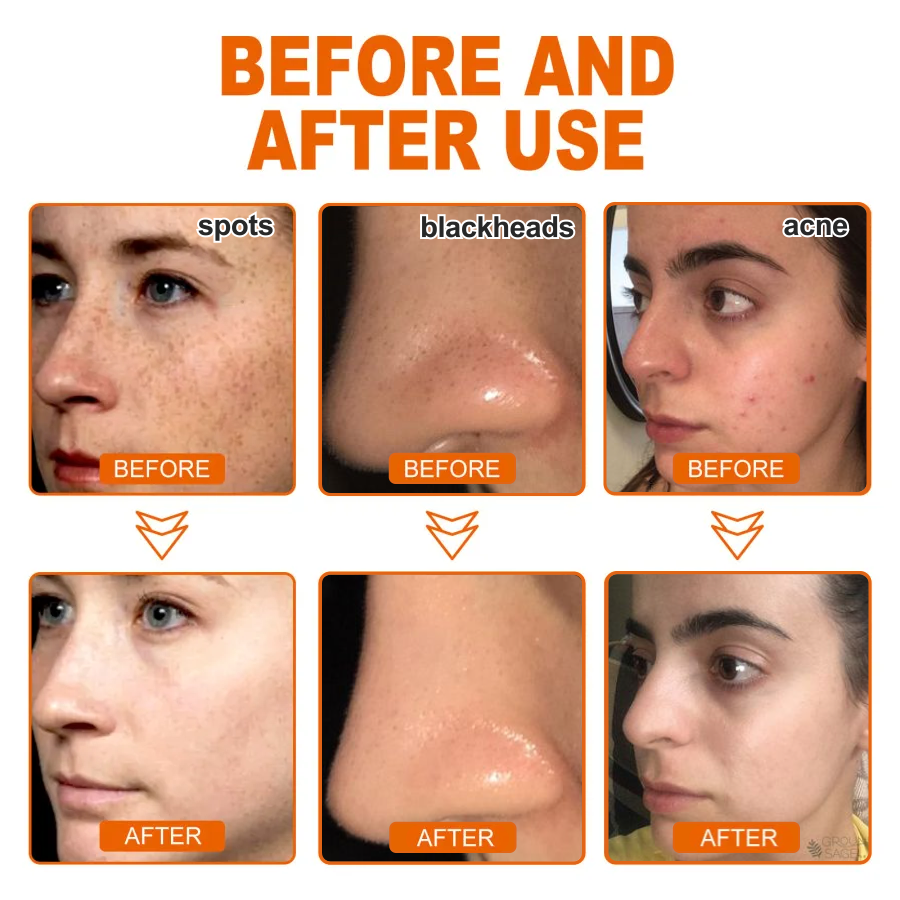 ✨2 kaufen+2 gratis✨Kräuter-Anti-Akne-Peel-Off-Maske